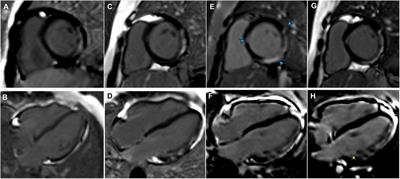 Case Report: Acute myocarditis in a patient with Duchenne muscular dystrophy